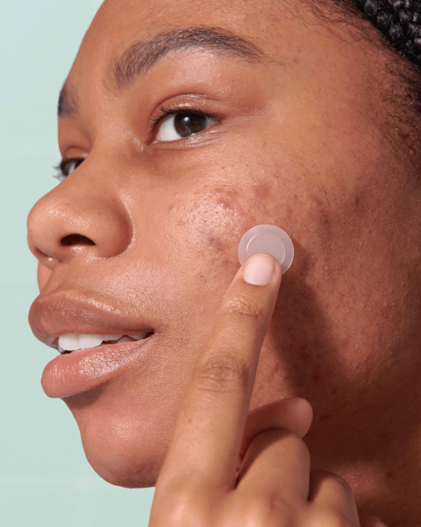 Might Patch - Micropoint for Blemishes