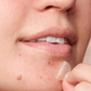 Might Patch - Micropoint for Blemishes