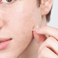 Might Patch - Micropoint for Blemishes